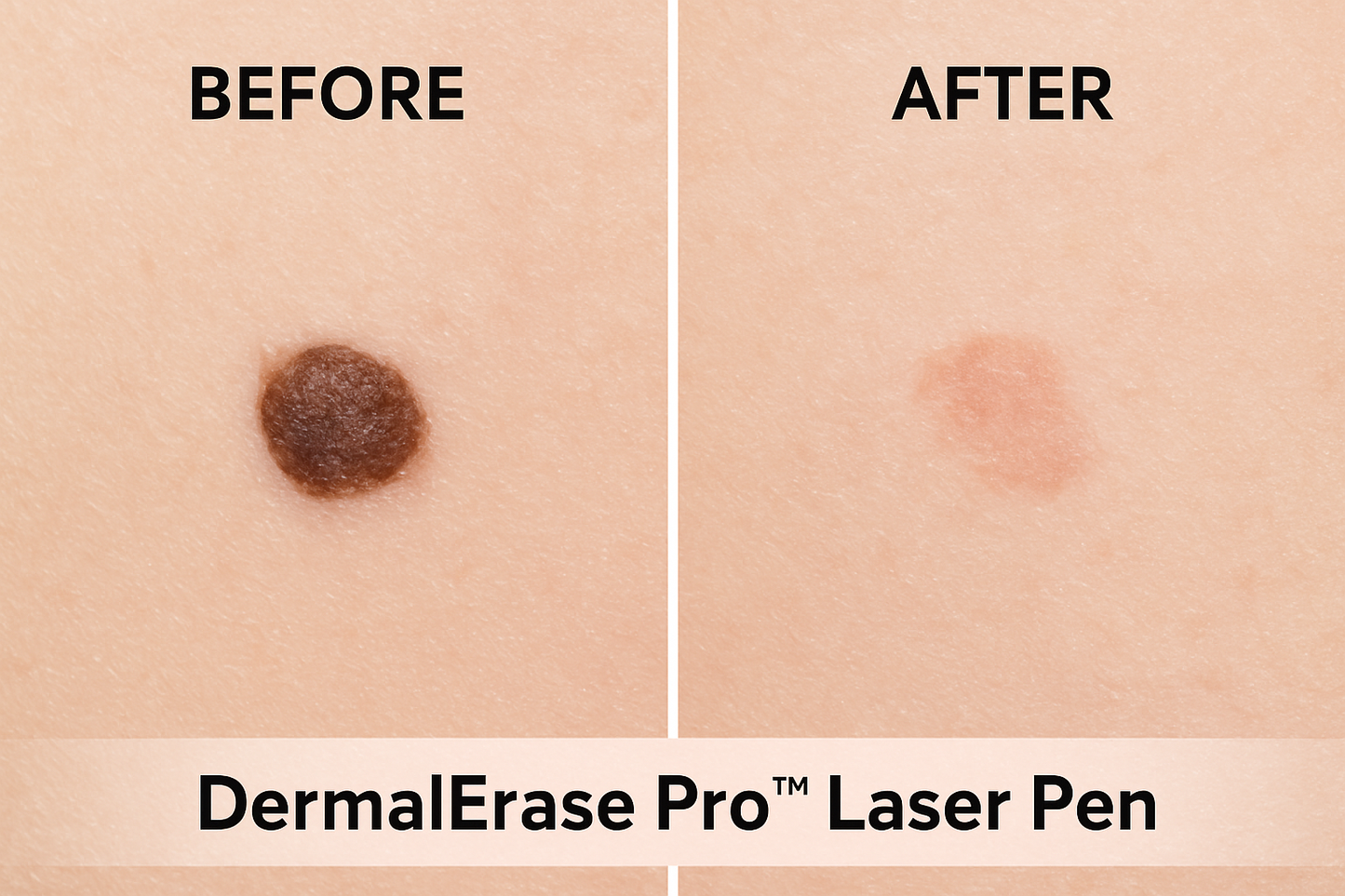 DermalErase Pro™ Laser Pen