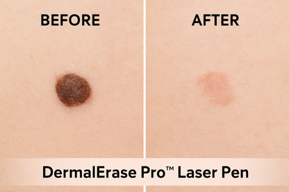 DermalErase Pro™ Laser Pen